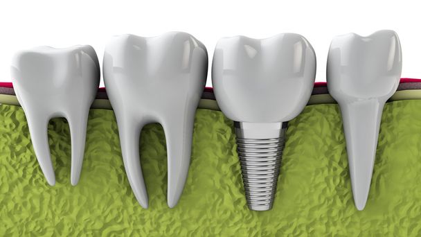 Understanding the Lifespan of Dental Implants